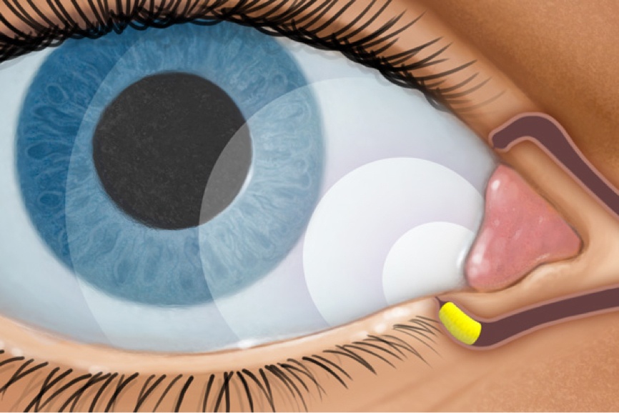 Illustration of Dextenza in the eye