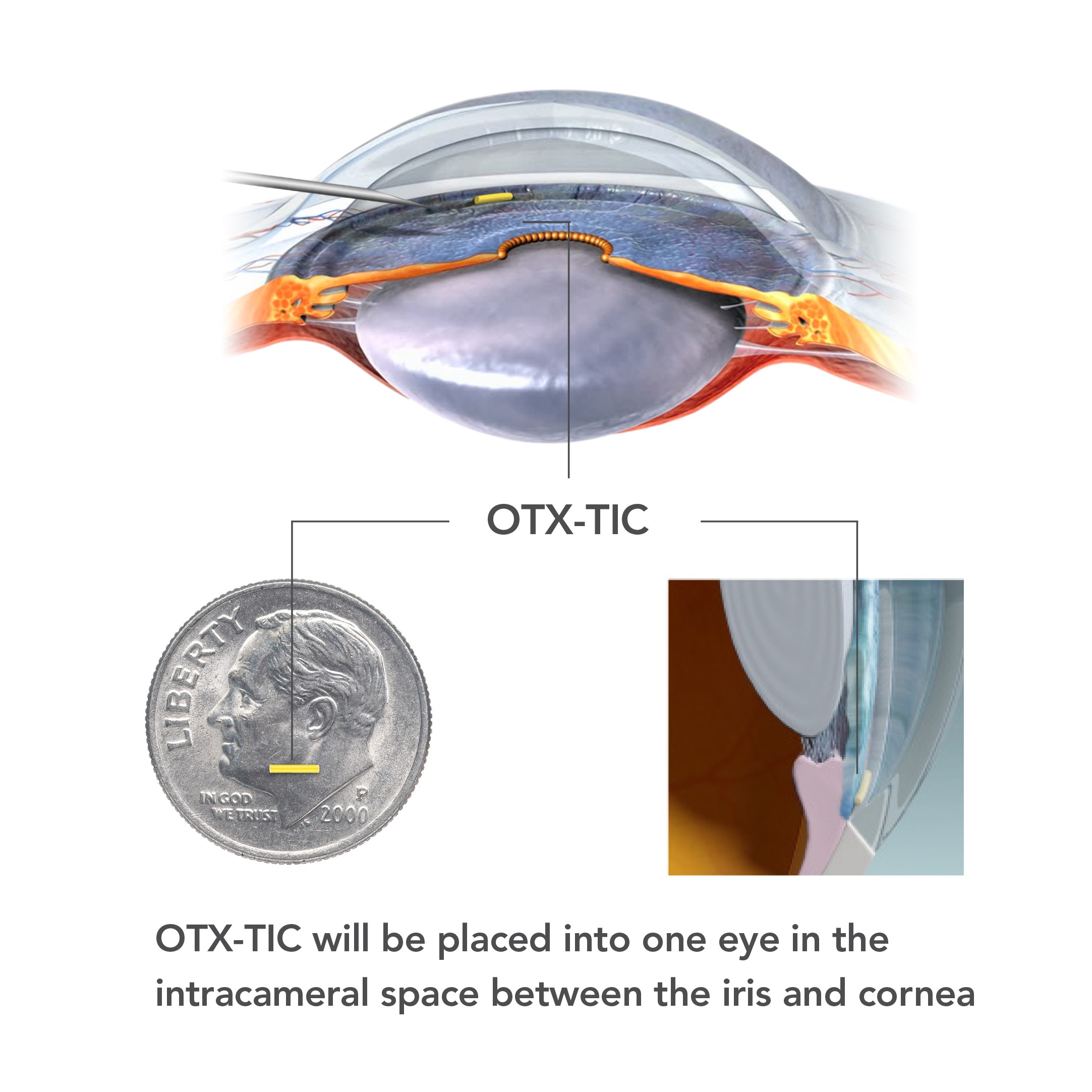 OTX-TIC Image